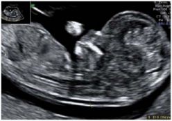 Clarte Nucale Et Nuque Foetale Docteur Guilherme Romain Clarte Nucale Et Nuque Foetale Docteur Guilherme Romain