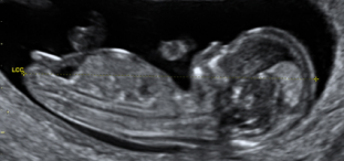 Sexe Du Bebe Au Premier Trimestre A L Echographie Fille Ou Garcon Docteur Guilherme Romain Sexe Du Bebe Au Premier Trimestre A L Echographie Fille Ou Garcon Docteur Guilherme Romain