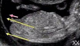Sexe Du Bebe Au Premier Trimestre A L Echographie Fille Ou Garcon Docteur Guilherme Romain Sexe Du Bebe Au Premier Trimestre A L Echographie Fille Ou Garcon Docteur Guilherme Romain