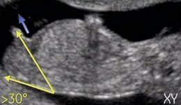 Sexe Du Bebe Au Premier Trimestre A L Echographie Fille Ou Garcon Docteur Guilherme Romain Sexe Du Bebe Au Premier Trimestre A L Echographie Fille Ou Garcon Docteur Guilherme Romain